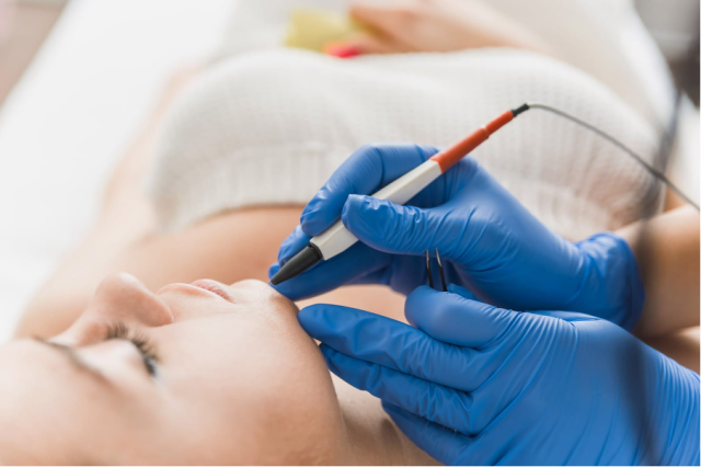 Electrolysis treatment at Laser Me Clinic