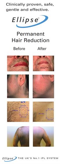 Elipse Hair Removal