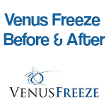 Venus Freeze - Before and After